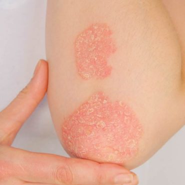 Moi, ma famille et mon pso ! La minute santé du psoriasis et du rhumatisme psoriasique